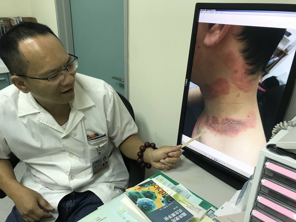 睡不好、壓力大要小心！上班族長紅疹、水泡罹帶狀疱疹pg