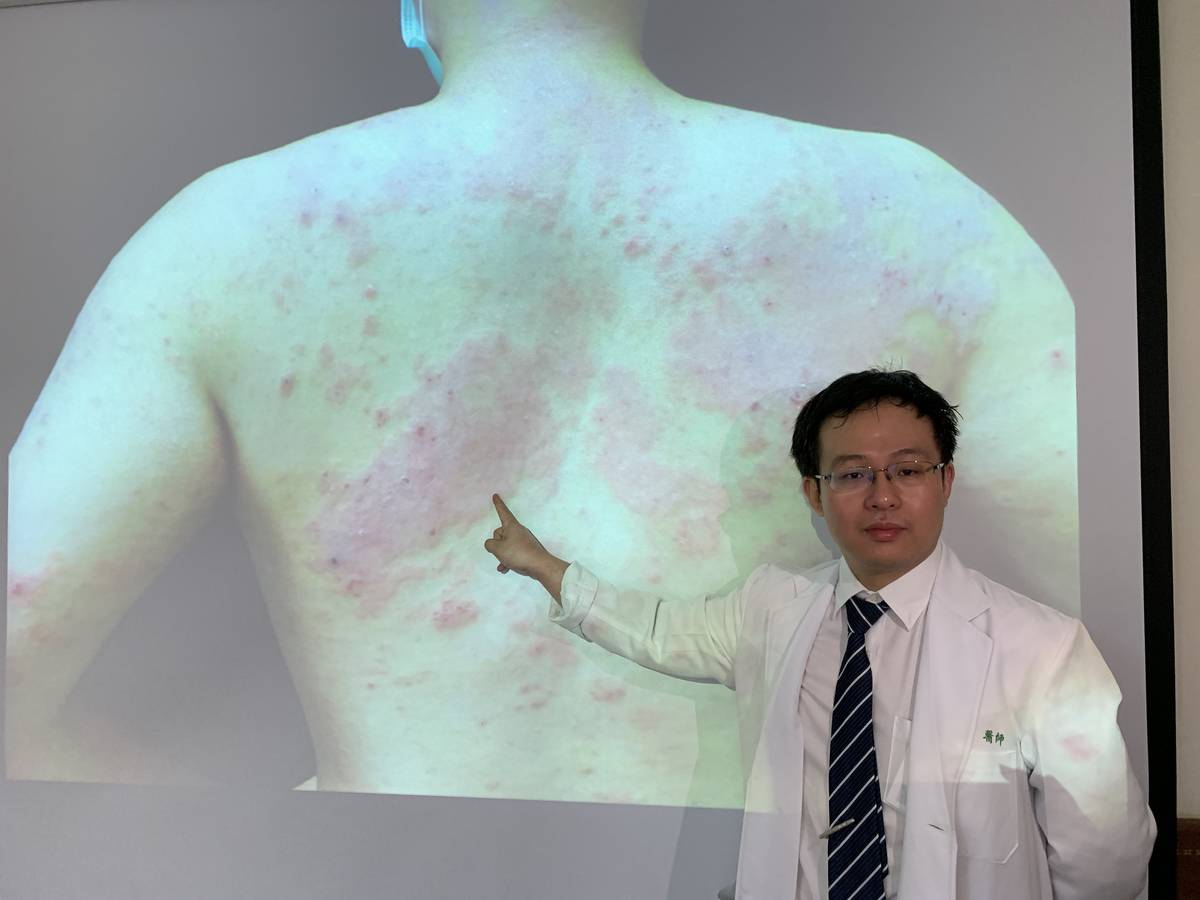 戰勝成人異膚必須積極就醫 新型藥物，改變人生!