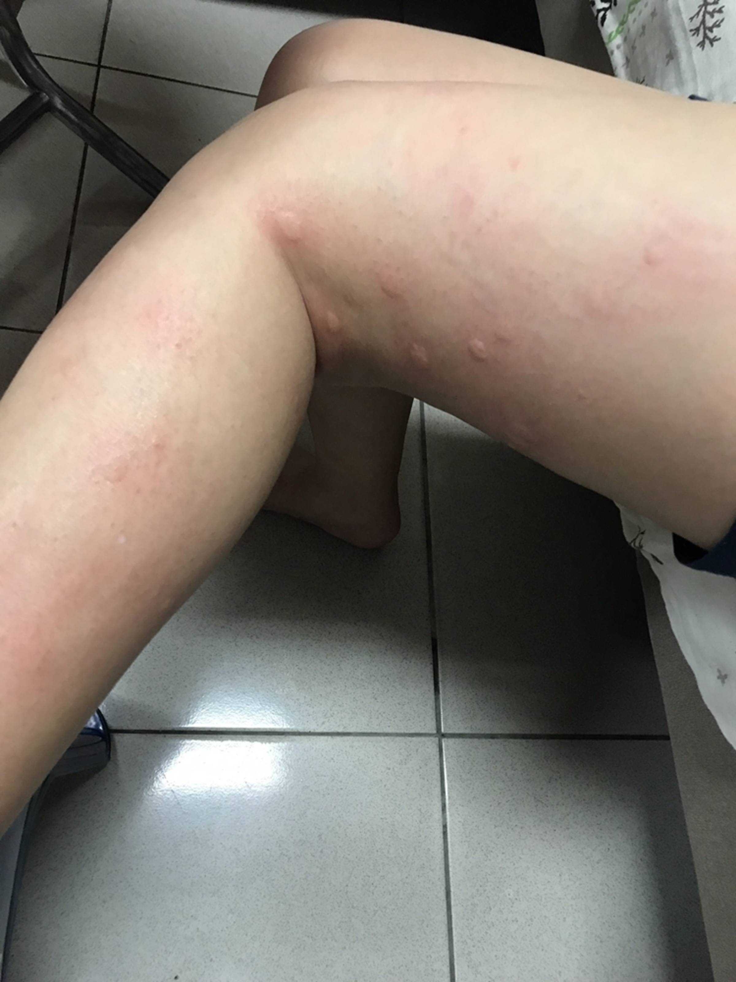 被小黑蚊叮咬不要抓冷水冰鎮可止癢- 文教新聞｜國立教育廣播電臺