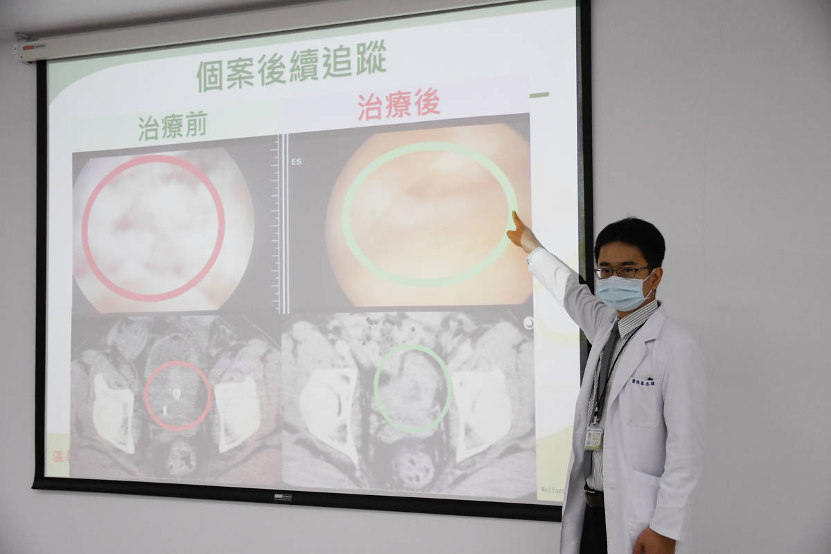 廖志穎主任指出病患接受整合四合一療法後腫瘤已縮小至1.5公分內
