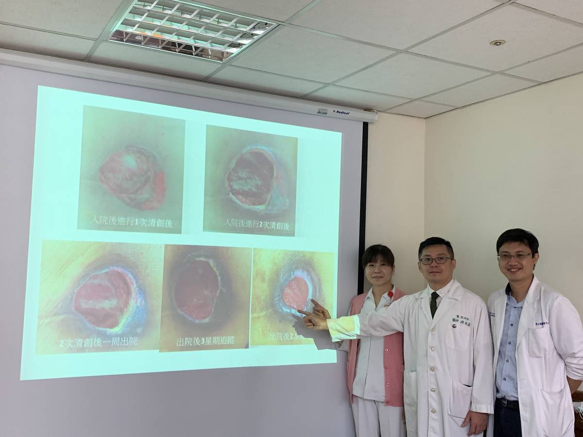 中山醫學大學附設醫院整形外科陳俊嘉主任指出因長期臥床導致臀部大片壓傷併皮膚潰爛情形