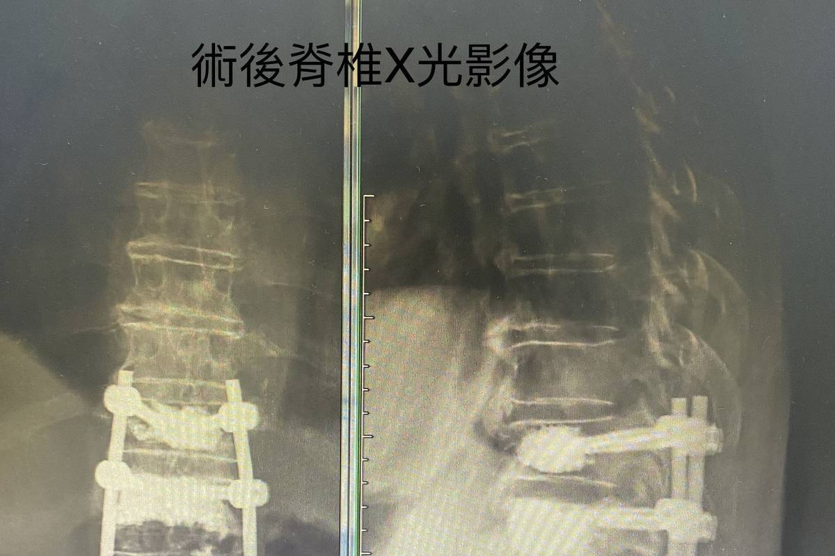 微創內固定手術