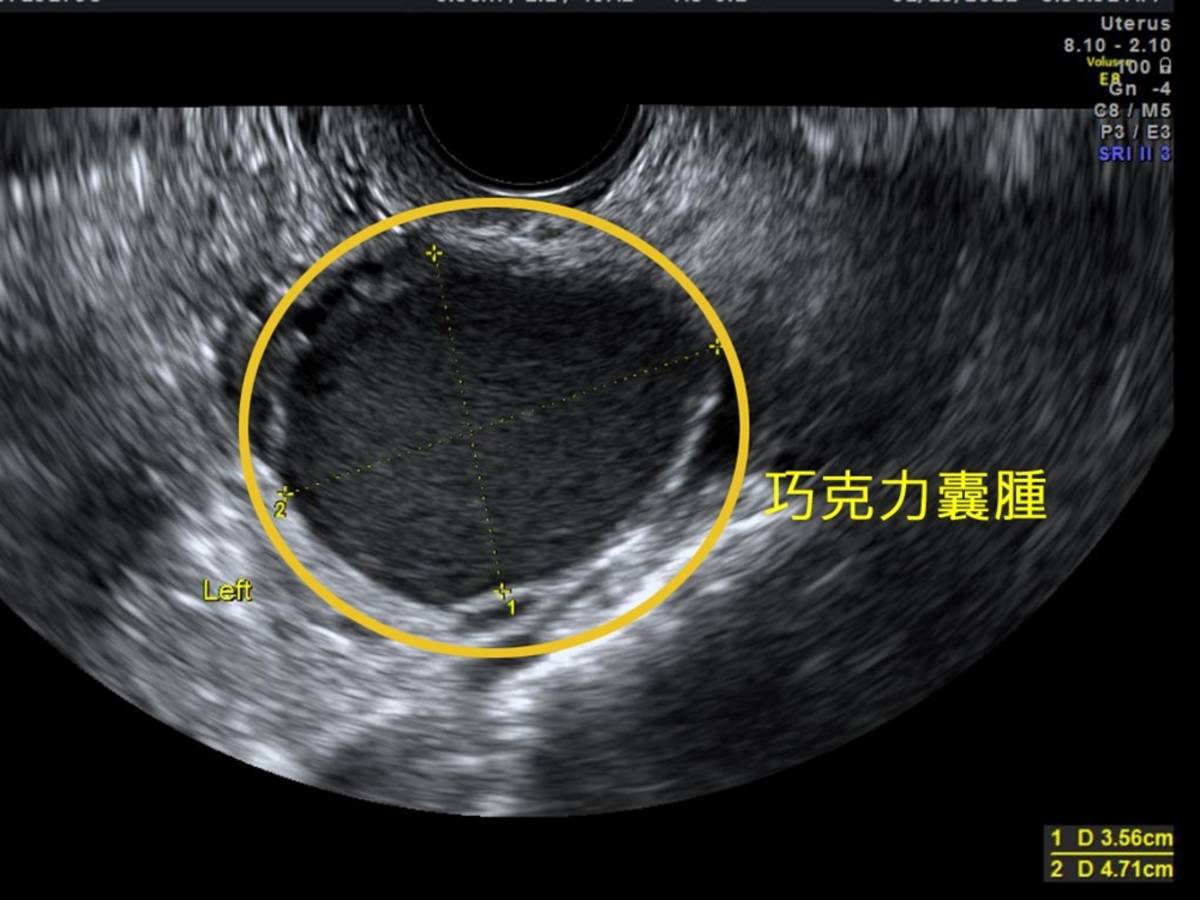超音波巧克力囊腫(門諾醫院提供)