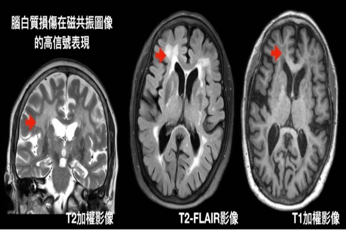 大腦白質照片示意圖 (陽明交大提供)