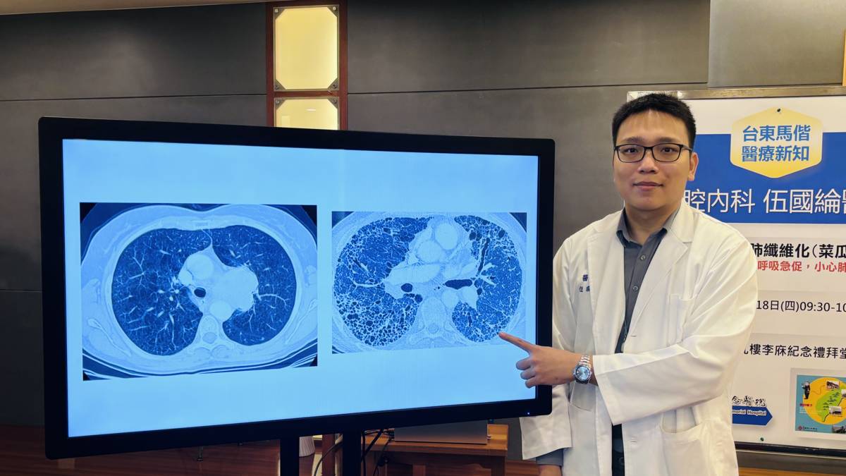 伍國綸醫師說明特發性肺纖維化