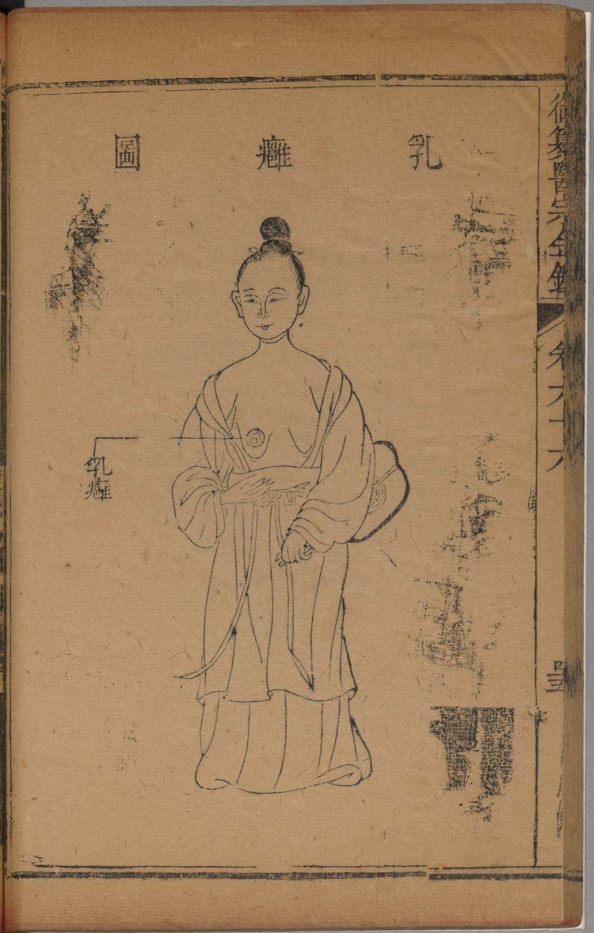 《御纂醫宗金鑑》乳廱圖(故宮提供)