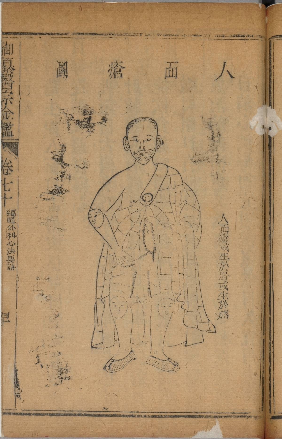 《御纂醫宗金鑑》人面瘡圖(故宮提供)