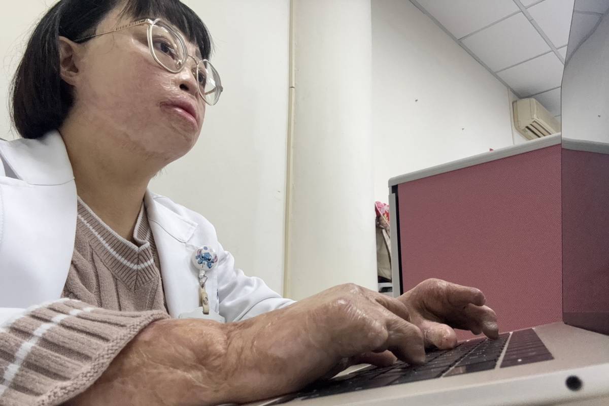 承怡9歲時因火災嚴重燒傷，即使成年了仍難忘傷痛