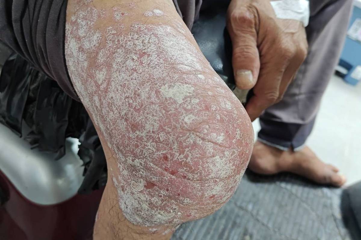 金峰鄉當地一位蔡姓獨居長者，長年受到乾癬症反覆發作的困擾，透過金峰衛生所遠距醫療專科門診，乾癬症獲得大幅改善。